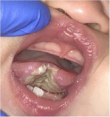 Case report: Hereditary sensory autonomic neuropathy presenting as bifid deformity to the tongue